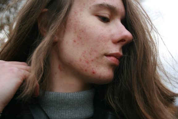 Acne Management Model with acne blemishes